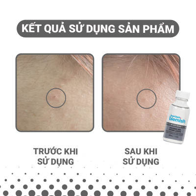 Chấm Mụn Tro Núi Lửa Giảm Mụn Nhanh Sau 1 Đêm Dành Cho Mụn Trắng, Sưng Đỏ Bye Bye Blemish Volcanic Ash Drying Lot