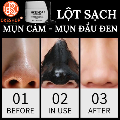 Gel Lột Mụn Than Tre Hoạt Tính OKESHOP 30ml - Giải Pháp Loại Bỏ Mụn Đầu Đen - Mụn Cám - Bạ Nhờn - Làm Sạch Sâu Và Thu Nhỏ Lỗ Chân Lông