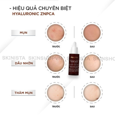SERUM TRỊ MỤN, KIỂM SOÁT DẦU NHỜN HYALURONIC ZNPCA MIXLAB SERUM
