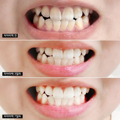 Kem đánh răng MEDIAN Dental IQ 93%