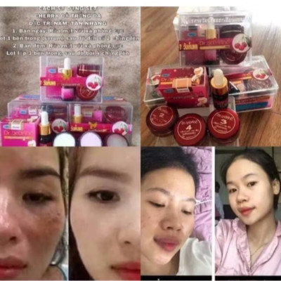 BỘ 5 MÓN KEM TRỊ HẾT NÁM TÀN NHANG DA THÂM SẠM TỪ THÁI LAN CAO CẤP CHO MỌI NGƯỜI 