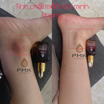Tinh Chất Serum Mờ Thâm Minh Khang - Hết mọi loại thâm, an toàn, lành tính sử dụng mọi lứa tuổi